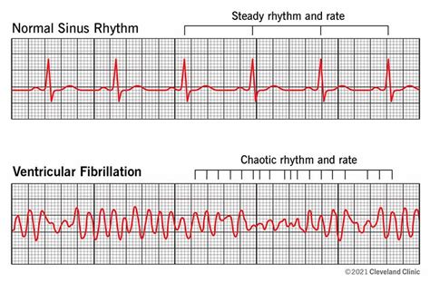 Ventricular Fibrillation (V-Fib): Symptoms & Treatment