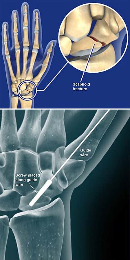 Scaphoid Fracture Open Reduction and Internal Fixation (ORIF) | Central Coast Orthopedic Medical ...