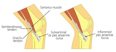 Pes Anserine Tendinopathy/Bursitis - Ultrasound Guided Injections