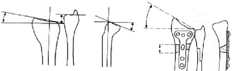 Distal Radius Osteotomy. (A) A malunion typically exhibits shortening... | Download Scientific ...