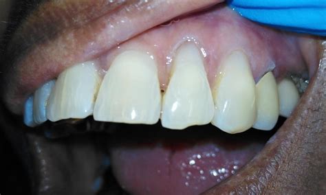 Dental Resin Filling Aurora | Smile Gallery | Prairie Dental Care