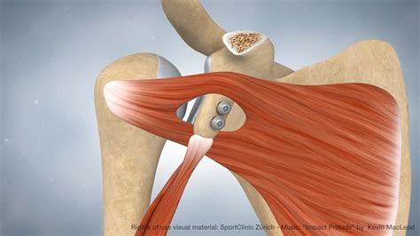 Animation Latarjet procedure - MedicalGraphics