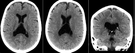 Radiology MRI: Cavum Velum Interpositum