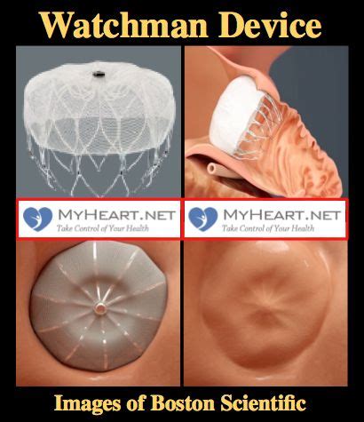 What is the Watchman Device (Also known as Watchman Procedure, Watchman Heart Procedure or ...