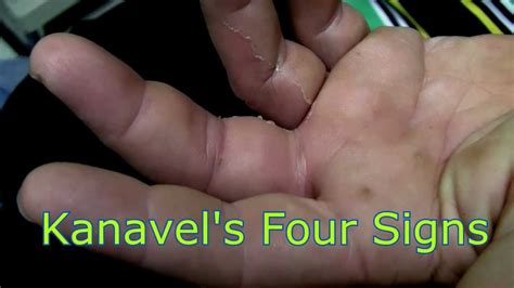 Kanavel's Four Cardinal Signs - YouTube