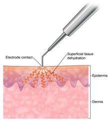 Electrodessication - The Skiny