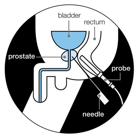 Prostate biopsy | Prostate Cancer UK