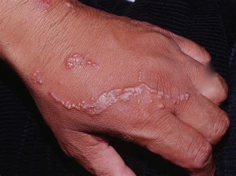 Poison Ivy Rash - Causes, How To Identify Poison Ivy Rash & Treatment