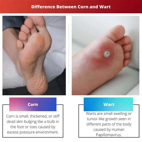 Corn vs Wart: Difference and Comparison