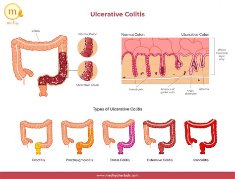 Pathophysiology Of Ulcerative Colitis