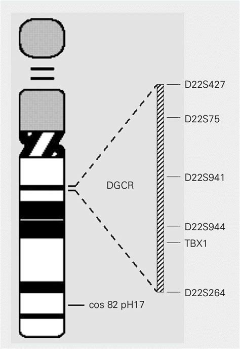 Idiogram of chromosome 22 illustrating the commonly deleted region ...