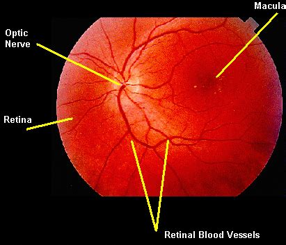 Macular Degeneration Drusen