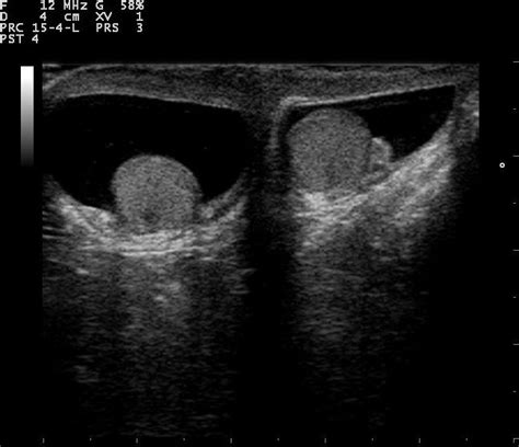 Ultrasound Imaging of Scrotum