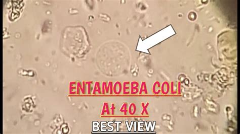 Entamoeba Coli best view in stool microscopy at 40X.E.Coli in stool microscopy.Parasites in ...