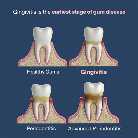 A Comprehensive Guide to Gingivitis