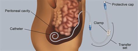 Types of Dialysis Access | Fresenius Kidney Care