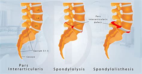 Spondylolisthesis Treatment at Spine One | Denver Spine Pain Specialists