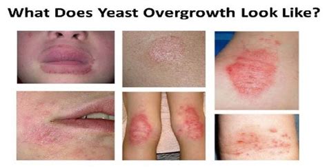 7 CAUSES OF CANDIDA OVERGROWTH | Yeast overgrowth, Candida overgrowth, Yeast infection cure