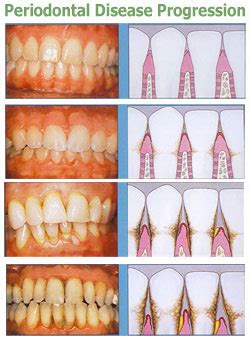 Periodontal Disease | Gilbert, AZ | Higley Park Dental, LLC