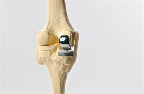 Partial Knee Arthroplasty | Dr. Michael Serhal