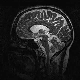 Top: Cerebral MRI displaying severe hypoplasia of the cerebellum and ...