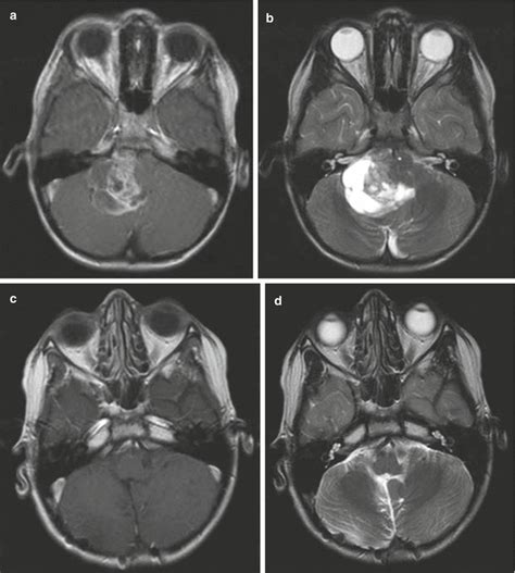 Ependymoma | Oncohema Key