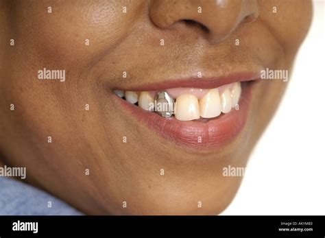 smile teeth gold tooth gold dentistry cap veneer grin Stock Photo: 4929714 - Alamy