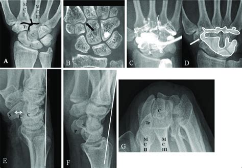 Normal anatomy of the quadrangular, midcarpal and (second to fifth) CMC ...