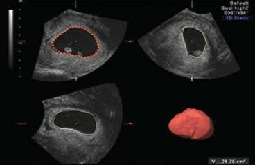 Volume measurement of the gestational sac in an 8-week pregnancy ...