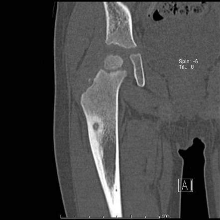 Osteoid Osteoma Mri Spine