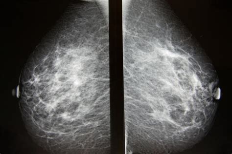 Mammogram Calcification