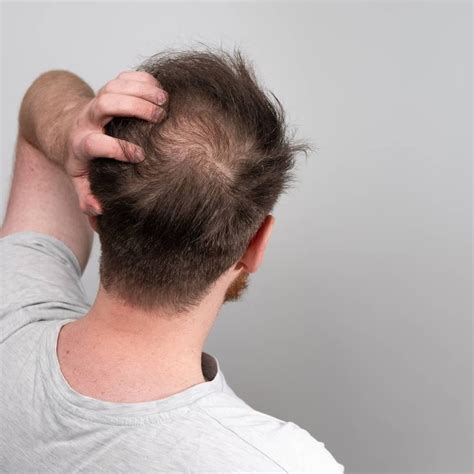 Male Pattern Baldness (Androgenic Alopecia): Stages, Treatment ...