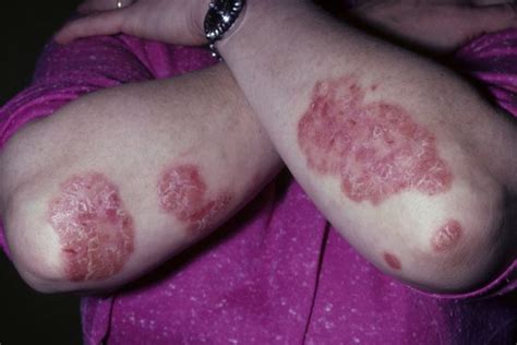 Coal Tar for Psoriasis: Alternative Treatment Update - Dermatology Advisor