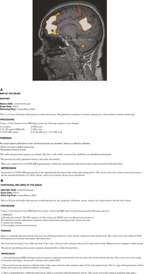 Mri Scan Result