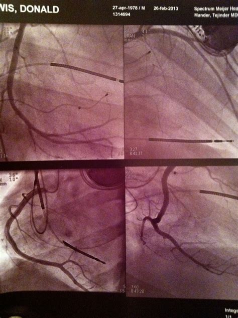 Heart Cath Procedure | Nursing school, Cardiology, Nurse