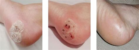 Blood Blister on Foot | Beaver Valley Foot Clinic