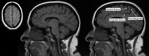 Radiological Anatomy: Central Sulcus - Stepwards