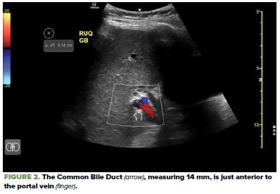 Where in The World is the CBD? Ultrasound Tips for Finding the Common ...