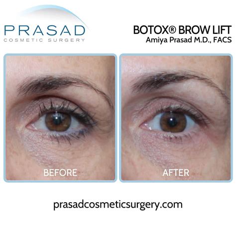 Brow Lift Before And After Photos Manhattan And Long Island, 51% OFF