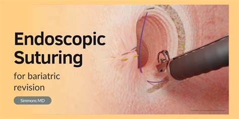 How Can Endoscopic Suturing Be Used for Bariatric Revision?