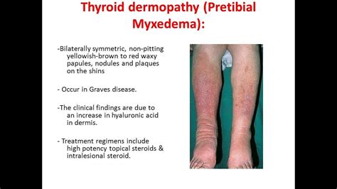 Clinical presentations of Myxedema resulting from Grave's disease - YouTube