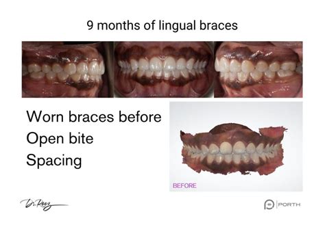 Invisible Braces | What is BRIUS lingual braces?