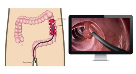 GI Procedures by Dr. Mona Dave, Pediatric Gastroenterologist in Southlake and Plano