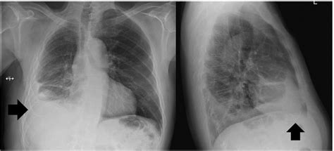 Complications of indwelling pleural catheter use and their management | BMJ Open Respiratory ...