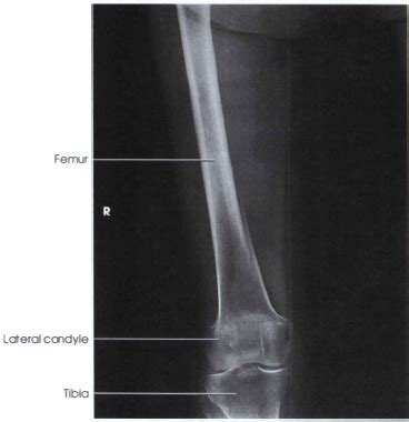 AP PROJECTION: FEMUR - MID AND DISTAL - RadTechOnDuty