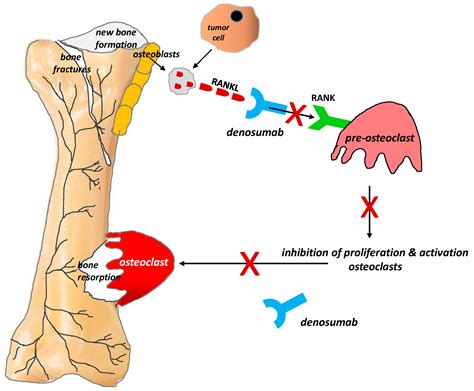 Bone mets pain comes and goes | doctorvisit