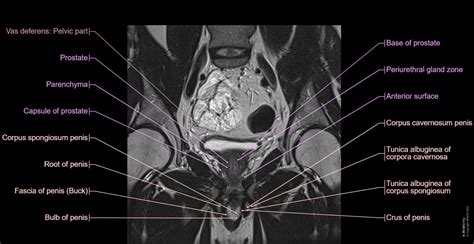 Mri Pelvis Anatomy Free Male Pelvis Axial Anatomy Mri - vrogue.co