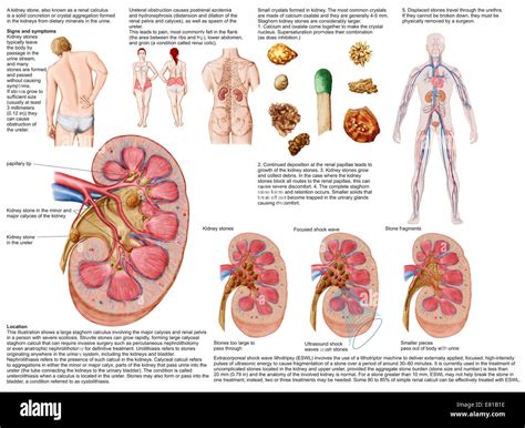 Medical chart showing the signs and symptoms of kidney stones Stock Photo - Alamy