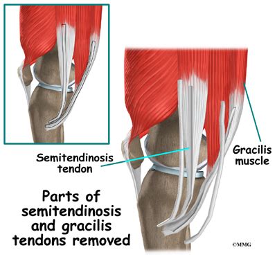 ACL Hamstring Tendon Graft Reconstruction | eOrthopod.com