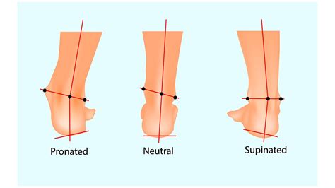 Causes of a Collapsed Ankle and How to Treat It - Regenexx